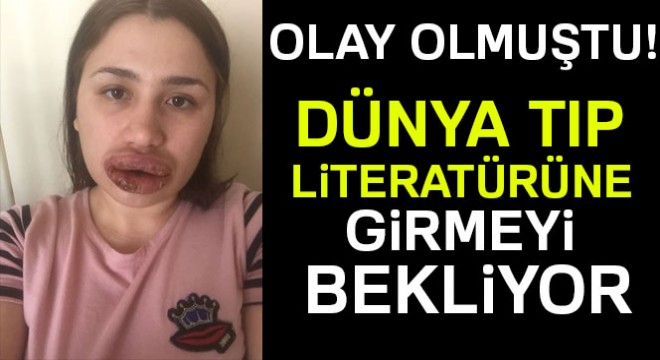 Merve Keleş in dudakları dünya tıp literatürüne girmeyi bekliyor